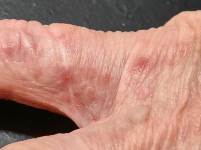 Milbengänge am rechten Kleinfinger