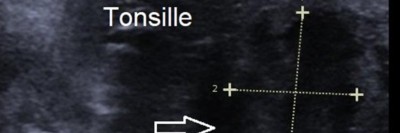 Peritonsillarabszess links