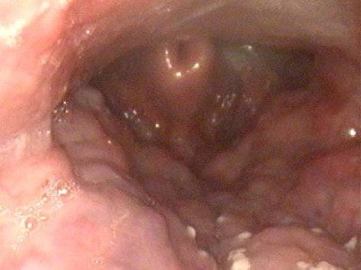 Omega-Epiglottis in Schlafvideoendoskopie