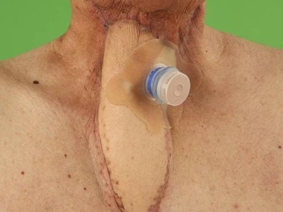 Defektrekonstruktion bei Fisteln des oberen Aerodigestivtrakts
