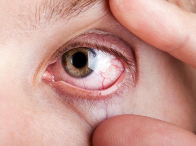 Rotes Auge