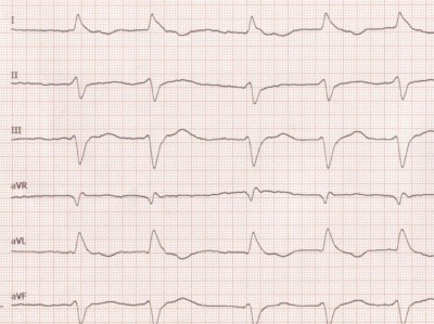 Extremitäten-EKG-Ableitungen