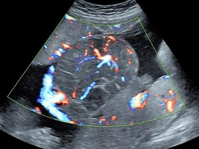 Dopplersonographie: Plazenta-Tumor mit hohem Blutfluss
