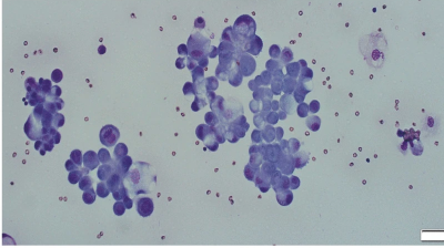 Cytopathology analysis of pleural effusion in patient with metastatic PTC