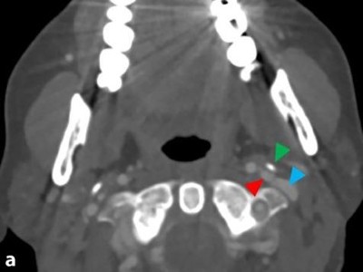 Schädel-Computertomographie (CT) ohne Kontrastmittel (a axial, b koronar)