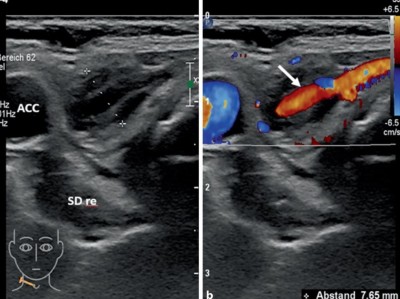 Sonographie der A. thyroidea