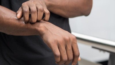 Person kratzt sich am Arm