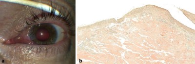 Amyloidose der Bindehaut
