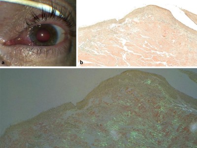 Amyloidose der Bindehaut