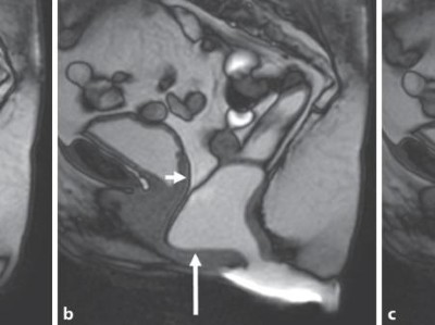 Patientin mit obstruktivem Defäkationssyndrom und Verdacht auf eine anteriore Rektozele