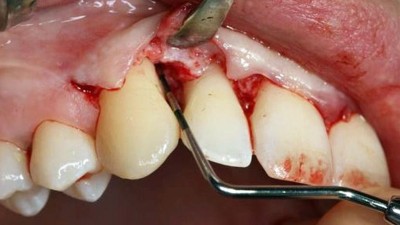 Interdentaler Knochenabbau aufgrund einer Parodontitis