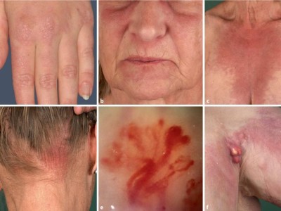 Dermatomyositis | Diagnose und Therapie der Myositis | springermedizin.de