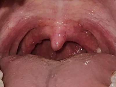 Typischer pharyngealer Befund einer viralen Tonsillopharnygitis