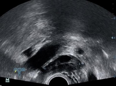 Präoperativer sonographischer Befund mit Verdacht auf Saktosalpinx rechts