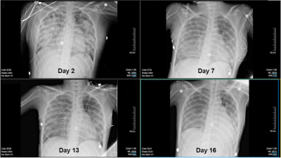 Chest x-ray of child with trauma-induced ARDS