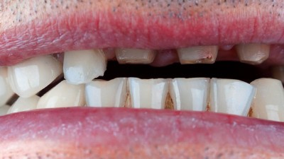 Halboffener Mund mit Zahnreihe und fehlenden Zähnen