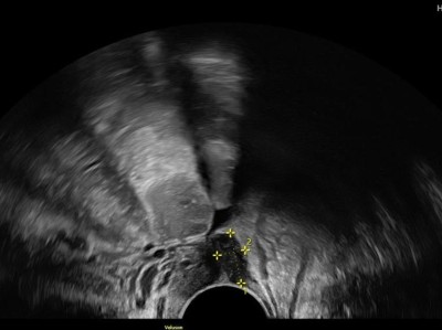 Endometriose-Befund im Ultraschall
