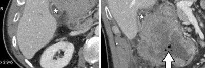 Adenokarzinom des Kolons mit Infiltration der Gallenblase