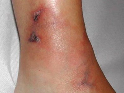 Typischer Hautbefund bei Panarteriitis nodosa