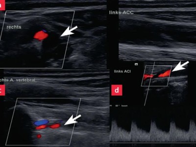 Duplexsonografische Befunde der Carotiden und der Vertebralarterien