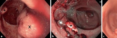 Abgerissener Rektumpolyp und blutender Stumpf