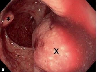 Abgerissener Rektumpolyp und blutender Stumpf
