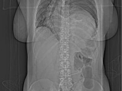 Verlagerung von Oberbauchorganen in den Thorax