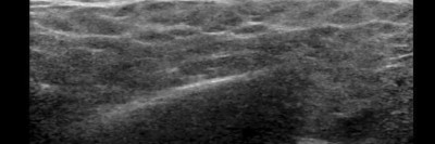 Speicheldrüsensonographie der Glandula parotis links bei Sjögren-Syndrom