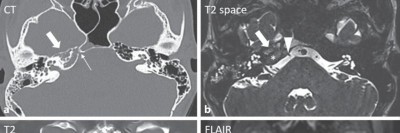 CT-Bildgebung und MRT eines inflammatorischen Pseudotumors