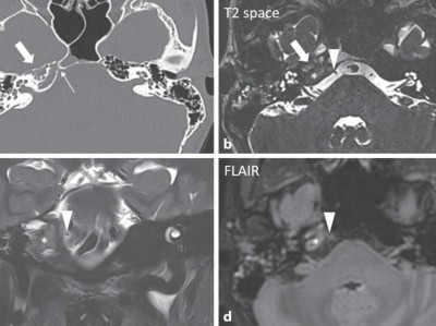 CT-Bildgebung und MRT eines inflammatorischen Pseudotumors