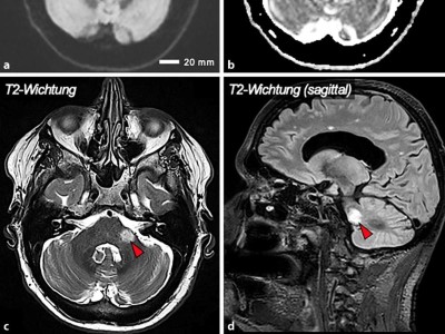 Zerebrovaskulärer Insult im Stromgebiet der Arteria cerebelli anterior inferior
