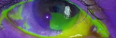Hornhautverletzung Fluoresceinfärbung