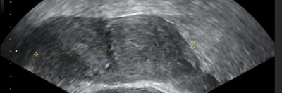 Transvaginalsonographie bei Uterus bicornis bicollis