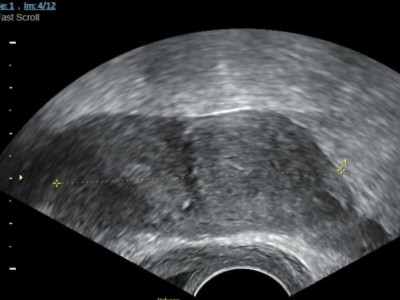 Transvaginalsonographie bei Uterus bicornis bicollis