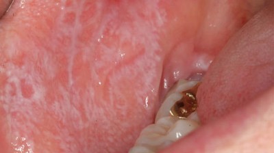 Oraler Lichen planus mit typischen weißlichen, netzförmigen Wickham-Streifen