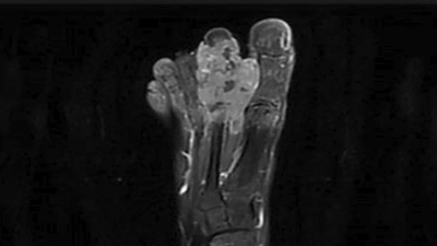 MRI of patient with clear cell sarcoma of soft tissue