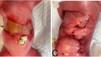 Image from case study_Newborn with symmetrical skin defects in the abdomen and bilateral trunk due to aplasia cutis congenita