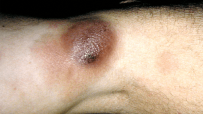 An arm with mycosis fungoides. A big dark red lump. A form of skin lymphoma. Abbreviated MF. Malignant cells in the skin that grow slowly.