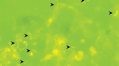 Image from case study_Acridine orange stain of CSF sample from a premature infant showing rod-shaped E. coli organisms