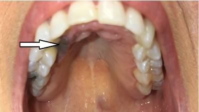 Initial evaluation of patient with oral mucosal melanoma