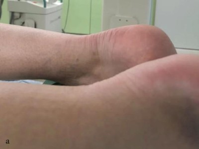 Achillessehnenruptur