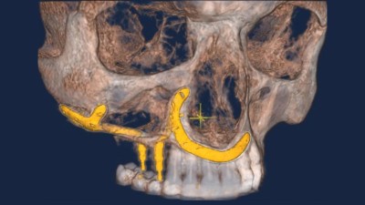 Postoperative 3D-Rekonstruktion der Digitalen Volumentomographie. Zu erkennen sind das patientenspezifische Implantat (PSI) und seine Verankerung am Jochbeinkörper sowie der paranasalen und anterioren Maxilla
