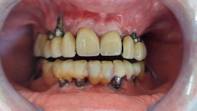  Klinischer Befund: prothetische Versorgung Regio 14, 13, 23, 24 und 34, 33, 43, 44, 28 Jahre post operation