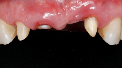 Oberkiefer: Hart und Weichgewebsdefizit. Zusätzlicher tiefer knöcherner Defekt von 5 mm mesial des Zahns 22