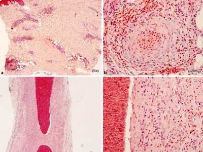 Probebiopsie eosinophile granulomatöse Polyangiitis