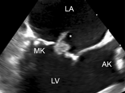 Bild einer Endokarditis der Mitralklappe