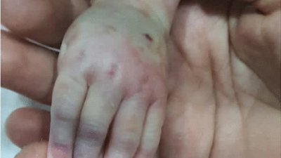 Image from case study_Neonate’s hand with local manifestations of acyclovir extravasation