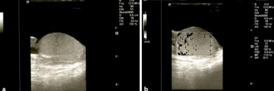 Ultraschallbefund einer klassischen sekundären Hydrozele