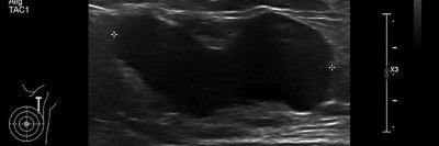Echoarmen Lymphknotenmetastase ohne Mark-Rinden-Struktur im Ultraschall