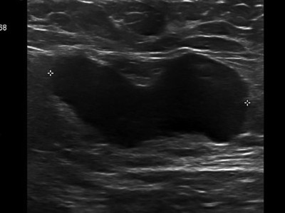 Echoarmen Lymphknotenmetastase ohne Mark-Rinden-Struktur im Ultraschall